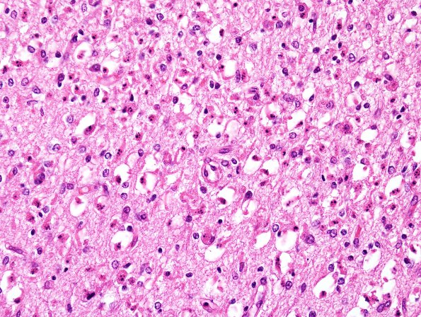 6A3 Hypoxia-Ischemia, neonatal, pontosubicular (Case 6) Subiculum H&E 2.