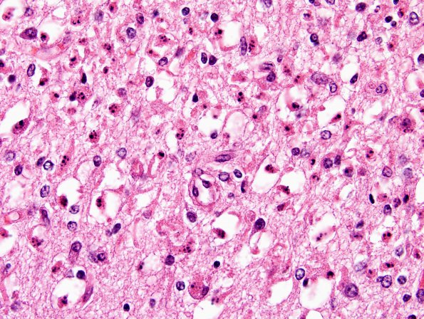 6A4 Hypoxia-Ischemia, neonatal, pontosubicular (Case 6) Subiculum H&E 1