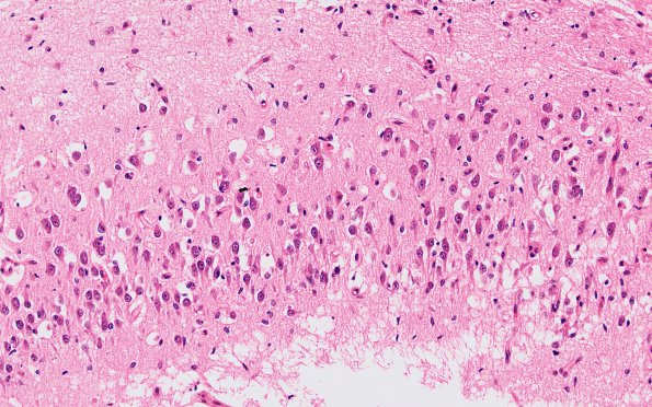 6A5  Hypoxia-Ischemia, neonatal, pontosubicular (Case  6) CA1 20X