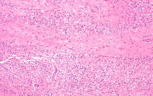 6B1 Hypoxia-Ischemia, neonatal, pontosubicular (Case  6) N7 10X 2