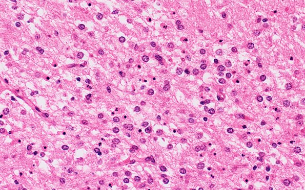 6B2 Hypoxia-Ischemia, neonatal, pontosubicular (Case  6) N7 40X