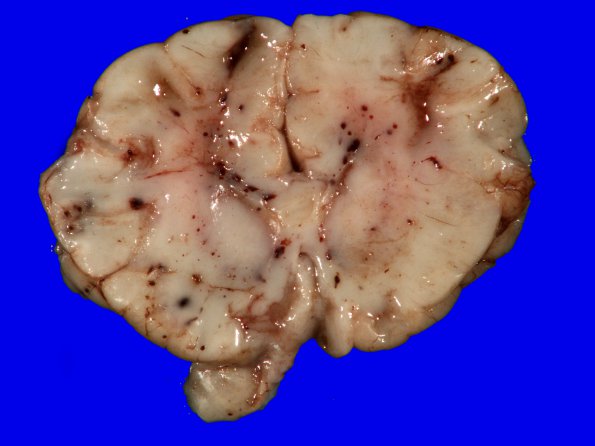 7A1 Hypoxia-Ischemia, neonatal, hemorrhage (Case  7)  X_1