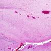 7B1 Hypoxia-Ischemia, neonatal, hemorrhage (Case  7) H&E subiculum 2