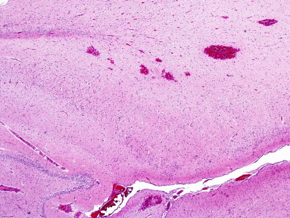 7B1 Hypoxia-Ischemia, neonatal, hemorrhage (Case  7) H&E subiculum 2