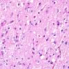 7B2 Hypoxia-Ischemia, neonatal, hemorrhage (Case  7) H&E subiculum 1 copy