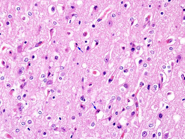 7B2 Hypoxia-Ischemia, neonatal, hemorrhage (Case  7) H&E subiculum 1 copy