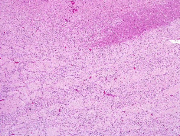 7C1 Hypoxia-Ischemia, neonatal, hemorrhage (Case  7) H&E pons 2