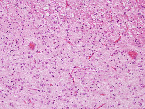 7C2 Hypoxia-Ischemia, neonatal, hemorrhage (Case  7) H&E pons 3