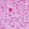 7C3 Hypoxia-Ischemia, neonatal, hemorrhage (Case  7) H&E pons 1