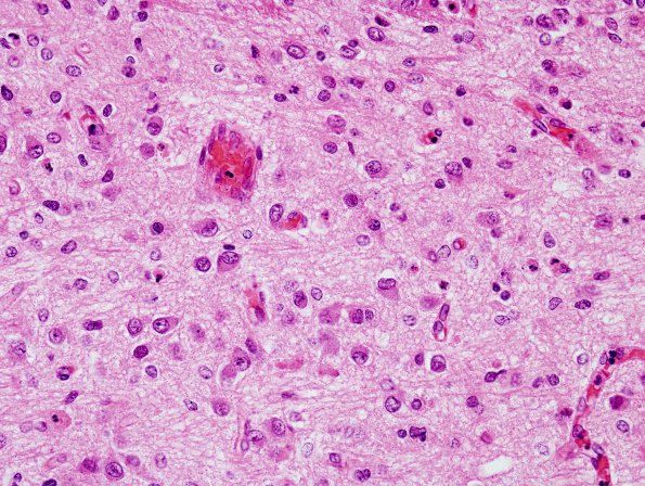 7C3 Hypoxia-Ischemia, neonatal, hemorrhage (Case  7) H&E pons 1