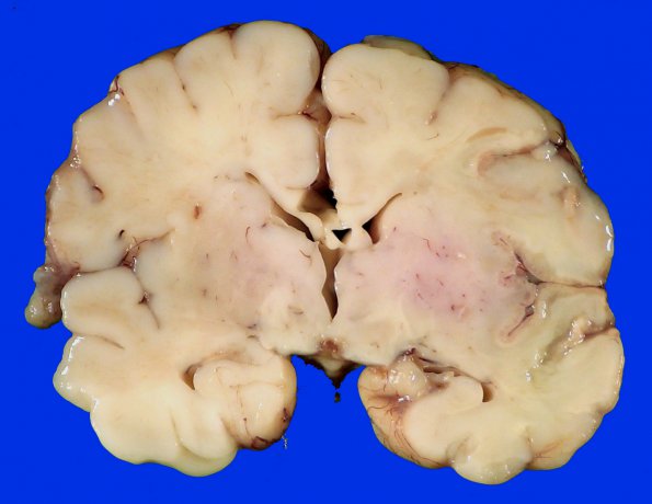 8A1 Pontosubicular necrosis (Case  8) N7 H&E _1