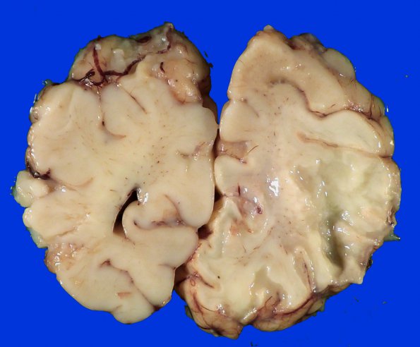 8A2 Pontosubicular necrosis (Case  8) N7 H&E _2