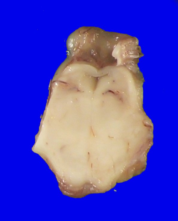 8A3 Pontosubicular necrosis (Case  8) N7 H&E _4