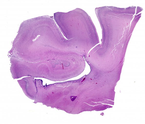 8B1 Pontosubicular necrosis N3 (Case 8) H&E WM 1