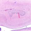 8B2 Pontosubicular necrosis (Case  8) N3 H&E 4X revised copy