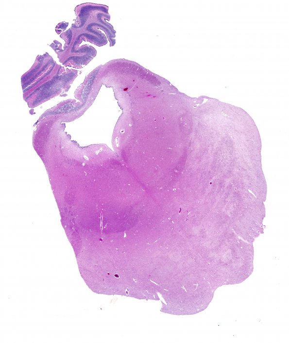 8C1 Pontosubicular necrosis (Case  8) N7 H&E WM 1