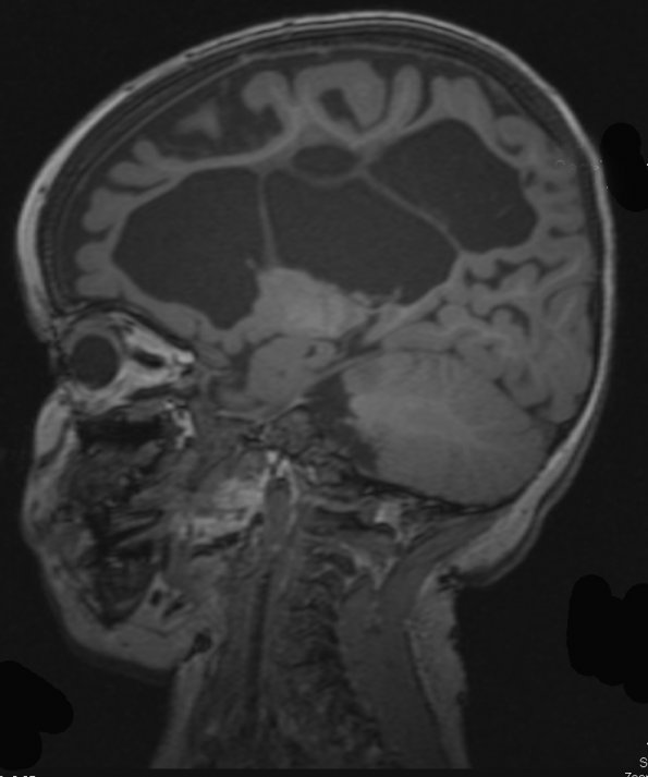 10A1 Porencephaly & MCA infarct (Case 10) MPR RANGE 1 - Copy