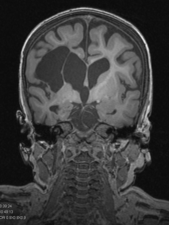 10A2 Porencephaly & MCA infarct (Case 10) T1 MPRAGE 1 - Copy