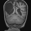 10A3 Porencephaly & MCA infarct (Case 10) T1 MPRAGE 3 - Copy