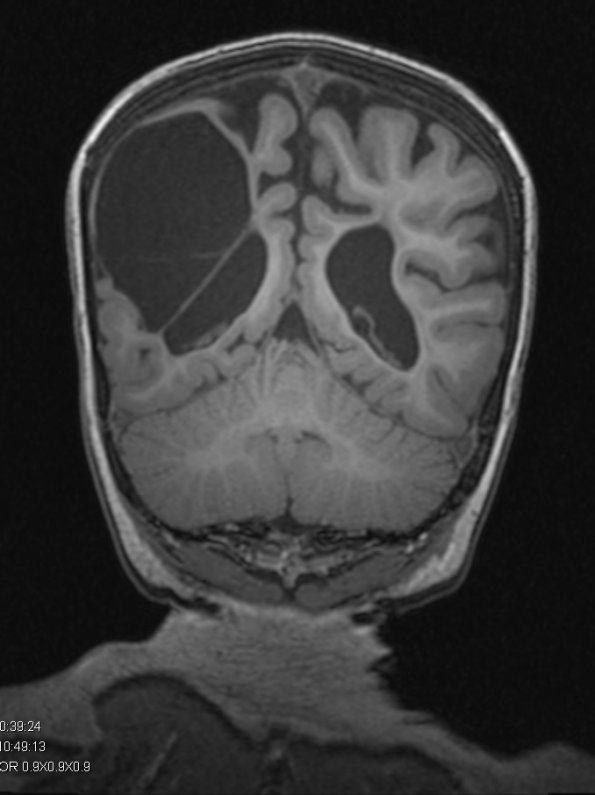 10A3 Porencephaly & MCA infarct (Case 10) T1 MPRAGE 3 - Copy