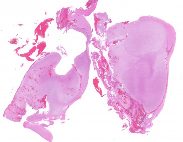 10B1 Porencephaly & MCA infarct (Case 10) H&E 1