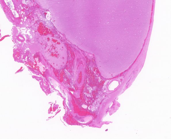 10B2 Porencephaly & MCA infarct (Case 10) H&E 2