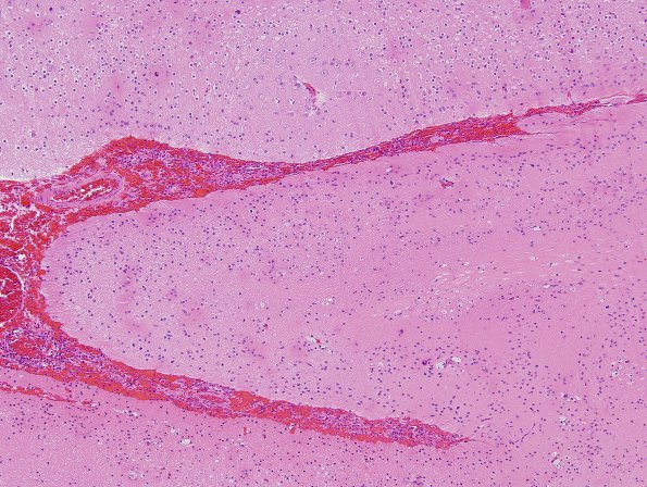 10B3 Porencephaly & MCA infarct (Case 10) H&E 4