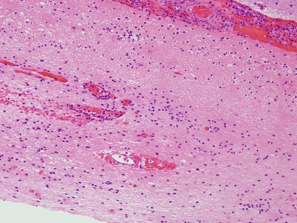 10B4 Porencephaly & MCA infarct (Case 10) H&E 5