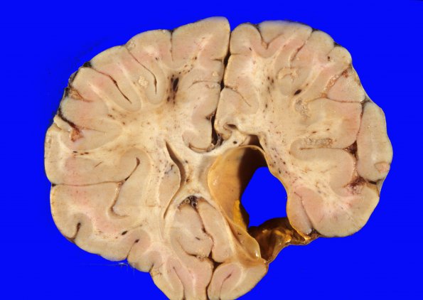 11A3 Porencephaly (Case 11) 3