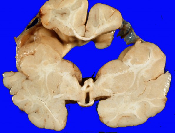 1A2 Porencephaly (Case 1) 2