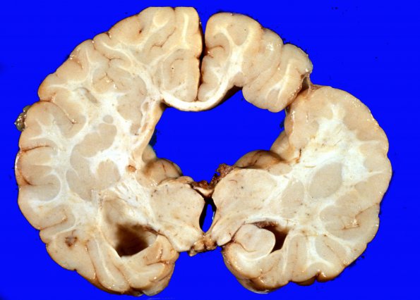 1A3 Porencephaly (Case 1) 47f