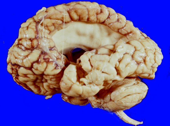 2A1 Porencephaly (Case 2) 10