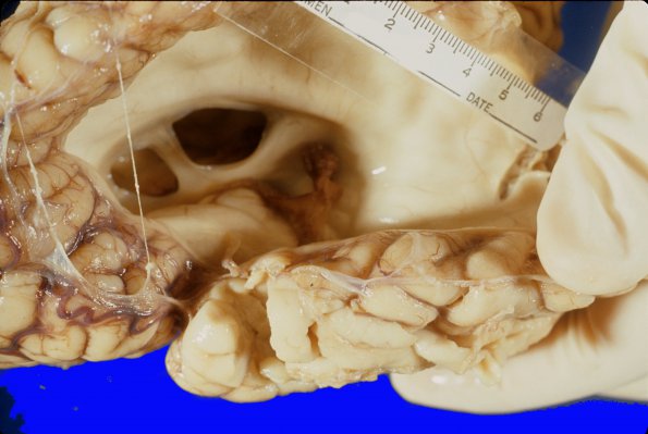 2A2 Porencephaly (Case 2) 2