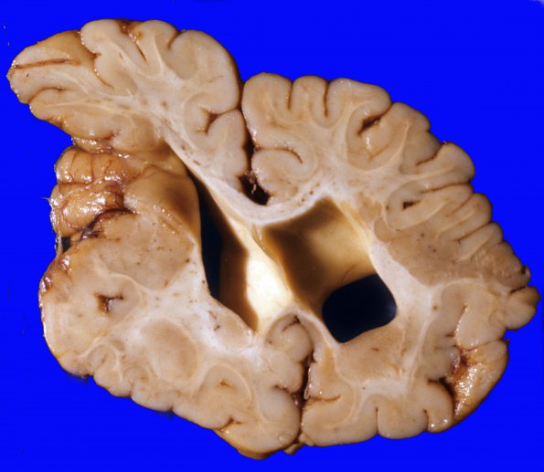 2A4 Porencephaly (Case 2) & heterotopia 3