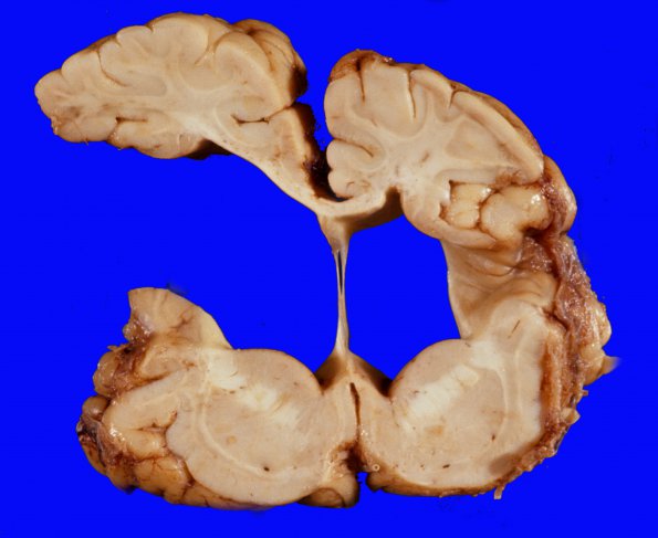 2A5 Porencephaly (Case 2) 5