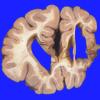 3A2 Infarct, chronic (Case 3) 1