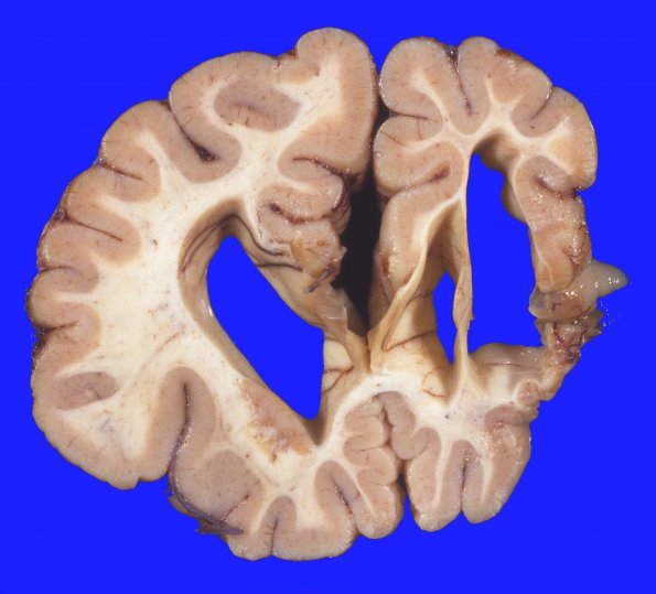 3A2 Infarct, chronic (Case 3) 1