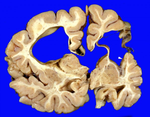 3A3 Porencephaly (Casee 3) 2 (prematurity H-I) copy