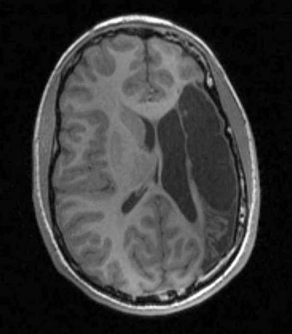 4A1 Porencephaly (Case 4) T1 2 - Copy