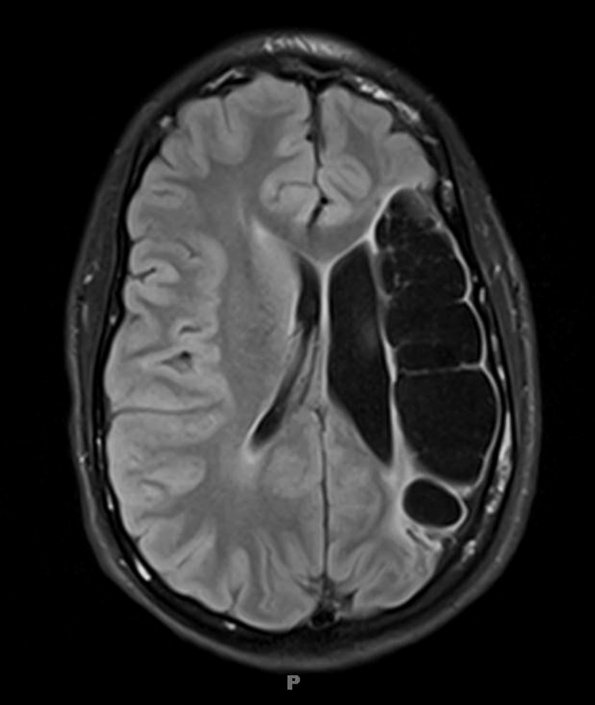 4A2 Porencephaly (Case 4) T1 5 - Copy