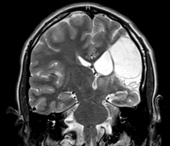 4A4 Porencephaly (Case 4) T2 3 - Copy