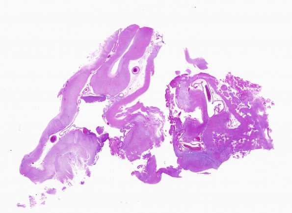 4B1 Porencephaly (Case 4) H&E whole mount