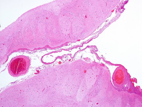 4B2 Porencephaly (Case 4) H&E 5