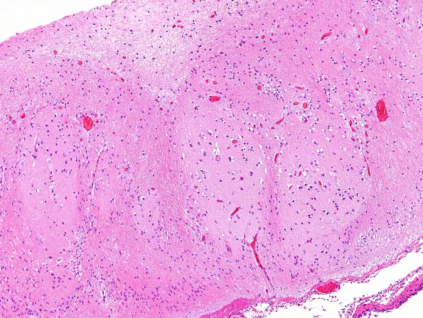 4B3 Porencephaly (Case 4) H&E 3