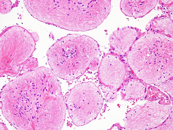 4B5 Porencephaly (Case 4) H&E 7