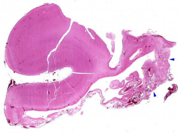 5A1 Porencephaly (Case 5) C4 H&E WM copy