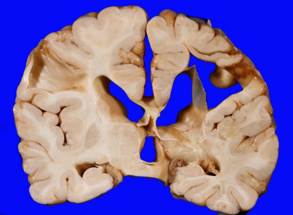 6A2 Porencephaly (Case 6) 9