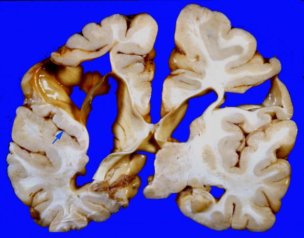 6A5 Porencephaly (Case 6) 47c copy A