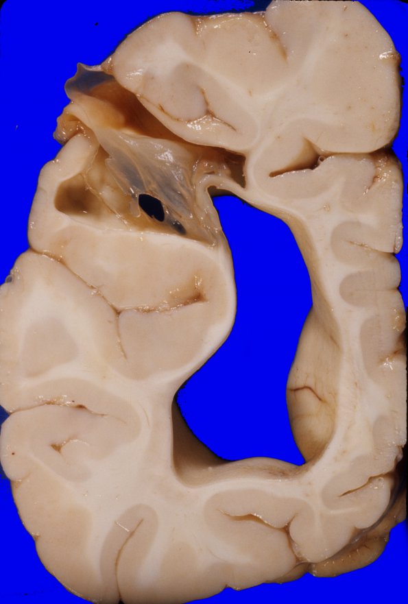 6A8 Porencephaly (Case 6) 2