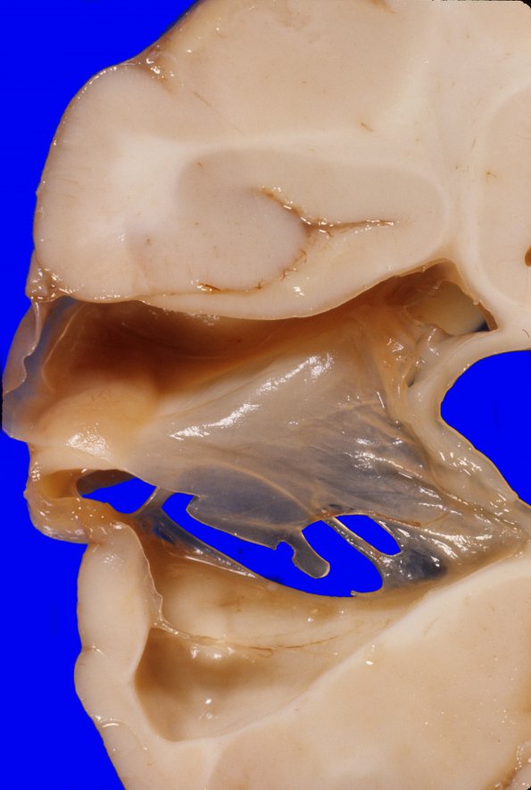 6A9 Porencephaly (Case 6) 3